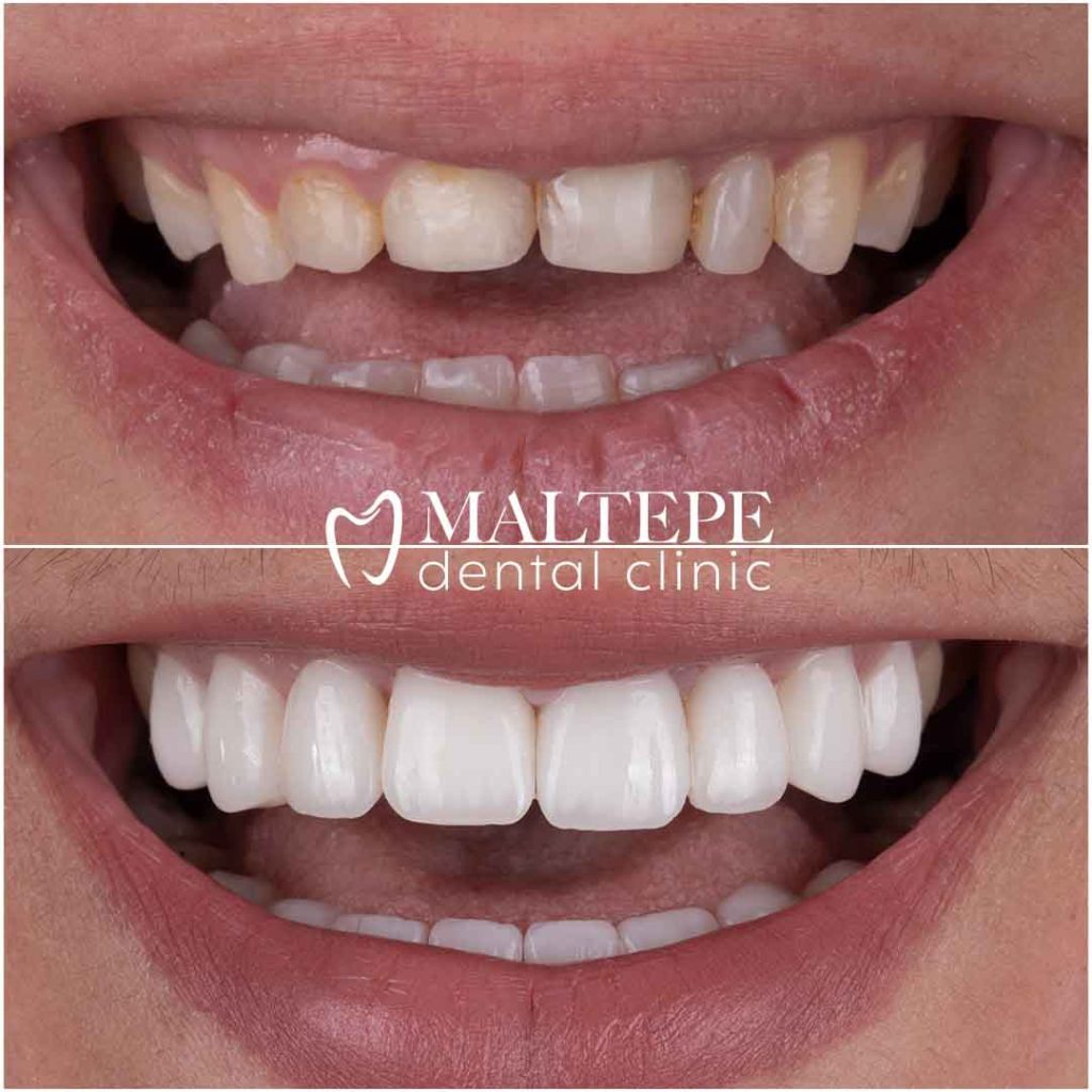 Everything You Would Like To Know About Gummy Smile - Maltepe Dental Clinic