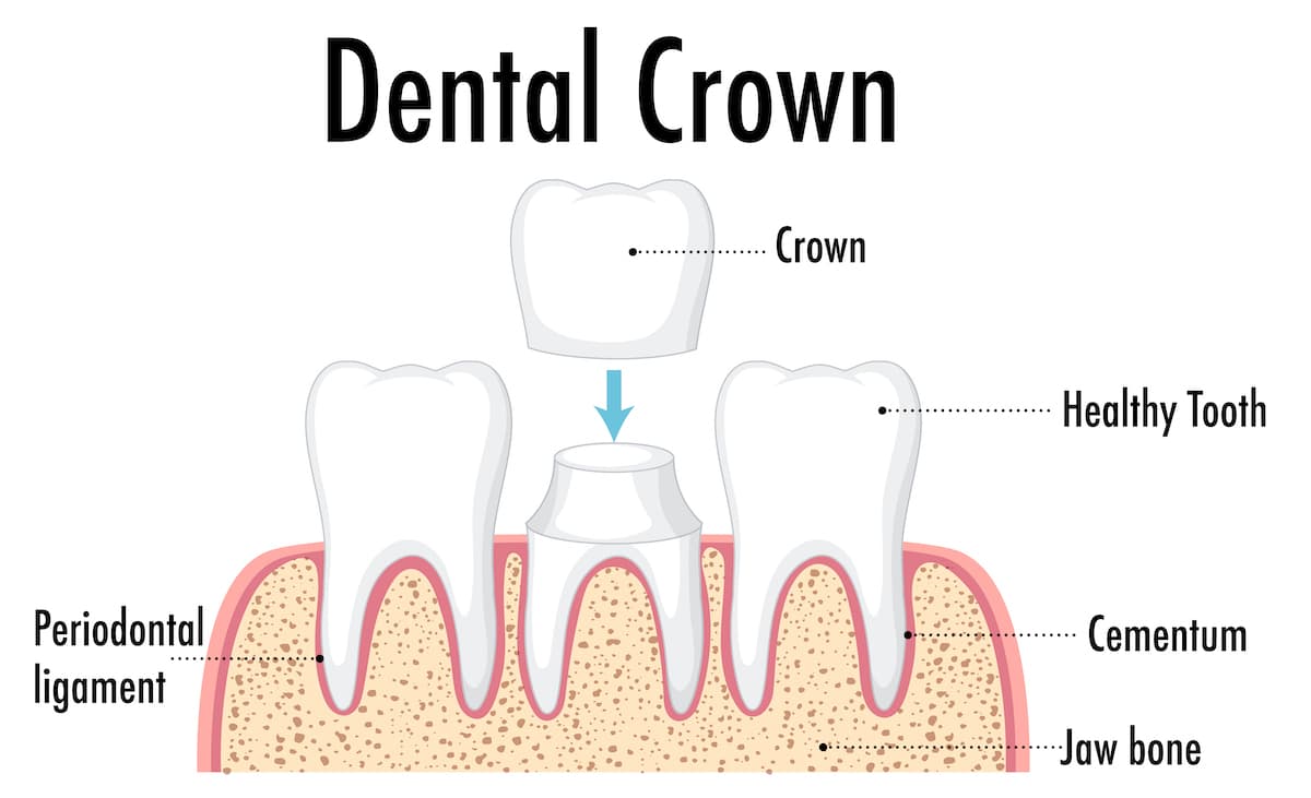 What Materials Are Dental Crowns Made Of? - Perkins Dental Care Baltimore  Maryland