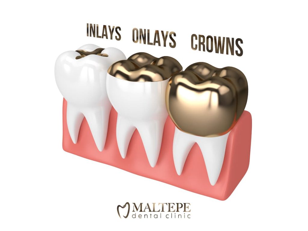 Dental Filling vs. Crown: Which is Right For Me?